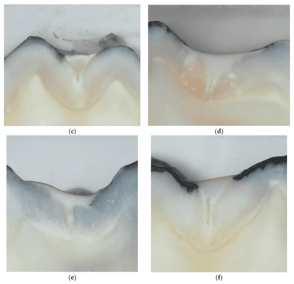 실란트 했는데 충치 생길거면 왜 해야되나요? 이유를 설명해드립니다 관련 이미지 3
