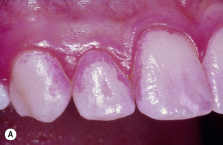 투스젬, 해도 문제 없을까? 치과의사가 생각하는 현실적인 3가지 문제점 관련 이미지 3