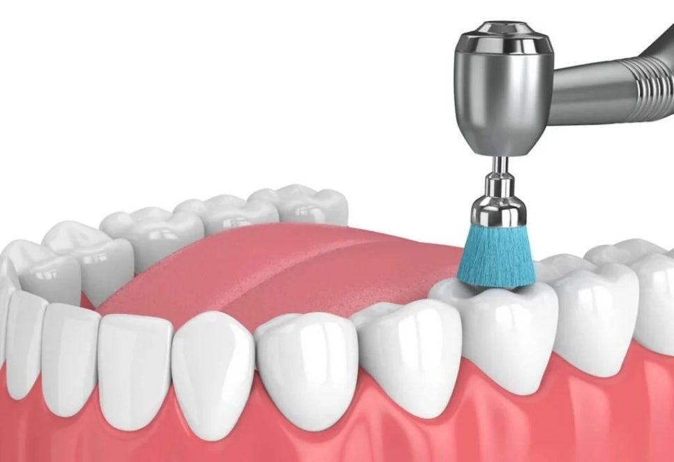 투스젬, 해도 문제 없을까? 치과의사가 생각하는 현실적인 3가지 문제점 관련 이미지 5