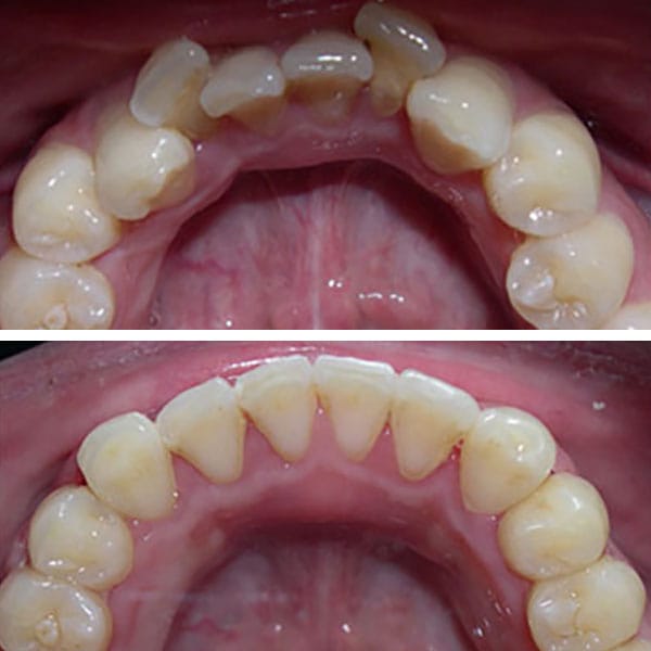 인비절라인 치료기간은 얼마나 걸릴까? 실제로 달라지는 요소들 관련 이미지 3