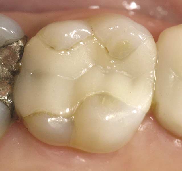 예전 인레이, 오래됐다면 교체해야 할까? 체크포인트는 이것 관련 이미지 4