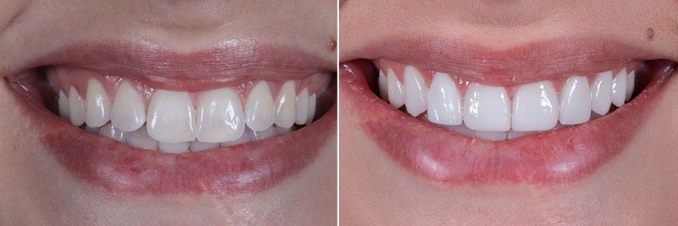 라미네이트 색상, 어떻게 고를까? ‘티 안 나는 자연스러움’의 기준 관련 이미지 4