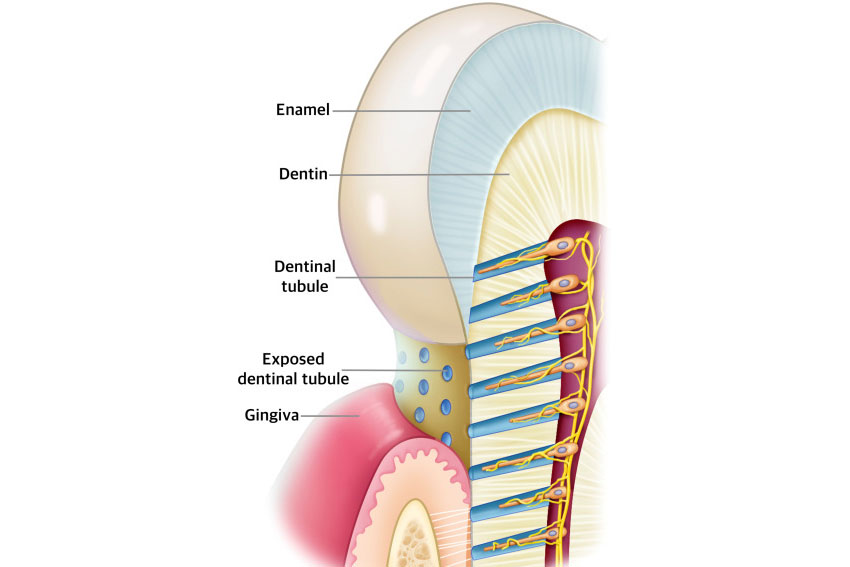 레진빌드업 후 시리다면? 정상 범위와 확인해야 할 점 관련 이미지 3