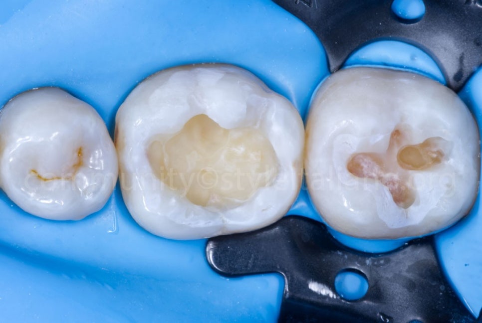 레진빌드업 후 시리다면? 정상 범위와 확인해야 할 점 관련 이미지 4