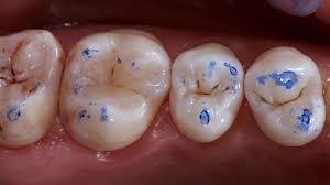 레진빌드업 후 시리다면? 정상 범위와 확인해야 할 점 관련 이미지 5