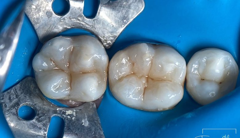 레진빌드업 후 시리다면? 정상 범위와 확인해야 할 점 관련 이미지 2