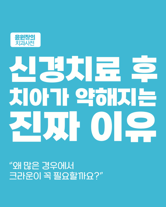 신경치료한 치아, 왜 약해질까? 크라운이 필요한 이유