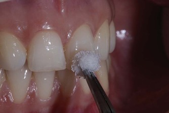 신경치료 전에 꼭 해야 할 검사, 이것이 성공률을 좌우합니다 관련 이미지 3