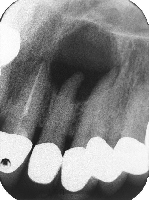 신경치료 전에 꼭 해야 할 검사, 이것이 성공률을 좌우합니다 관련 이미지 4