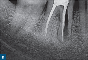 딱딱한 거 씹다 치아가 깨졌다면? 꼭 확인해야 할 손상 범위 관련 이미지 5