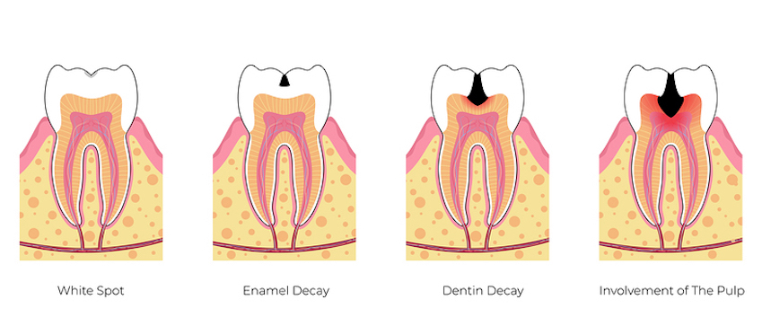 무불소 치약만으로 충분할까? 장단점과 선택 기준 관련 이미지 4