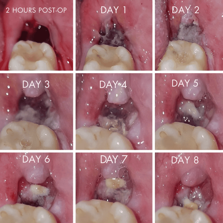 사랑니 발치 후 하얀 막처럼 보인다면? 정상 회복과 내원 신호